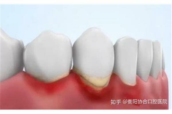 牙石怎么去除