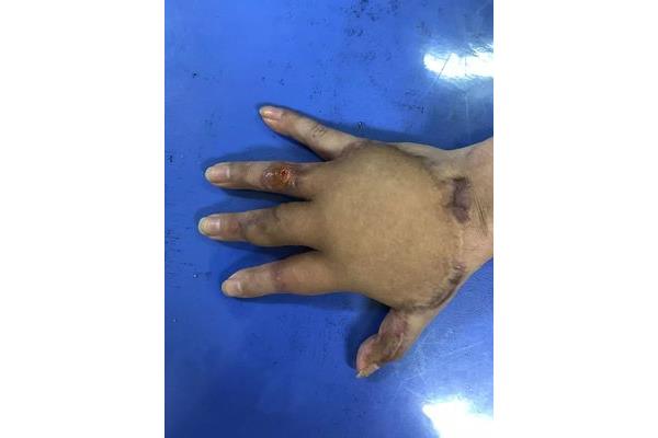 腹部手术拆线时间