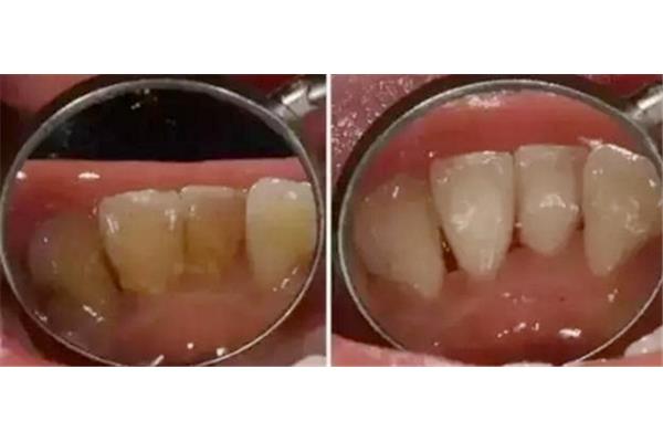 牙石怎么去除