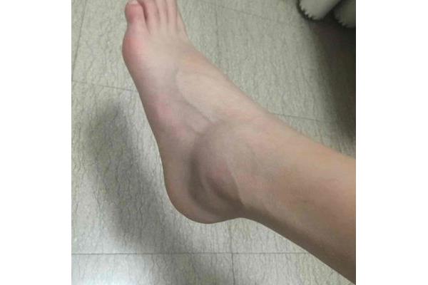 膝盖肿痛什么原因