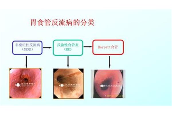食管反流怎么治疗