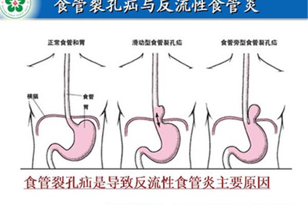 食管反流怎么治疗