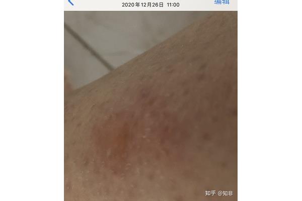 低温烫伤怎么办