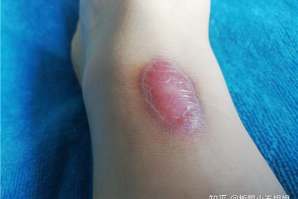 低温烫伤怎么办