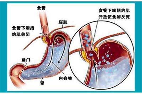 食管反流怎么治疗