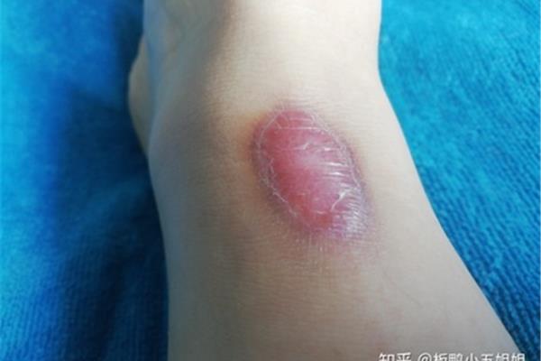 低温烫伤怎么办