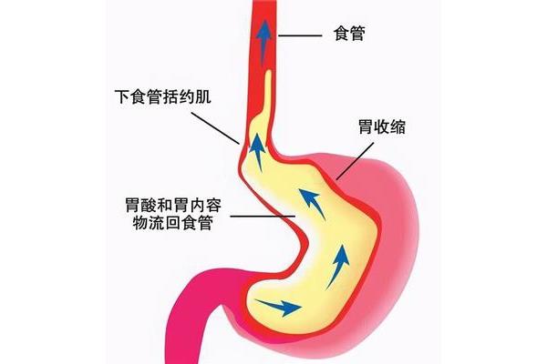 食管反流怎么治疗