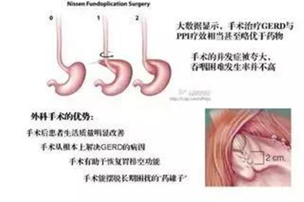 食管反流怎么治疗