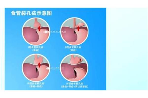 食管反流怎么治疗