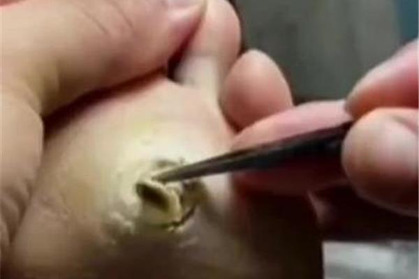 甲沟炎修脚