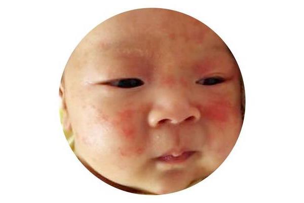 宝宝过敏症状