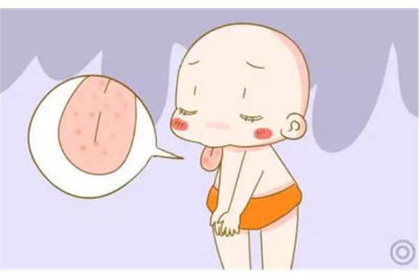 婴儿舌苔白