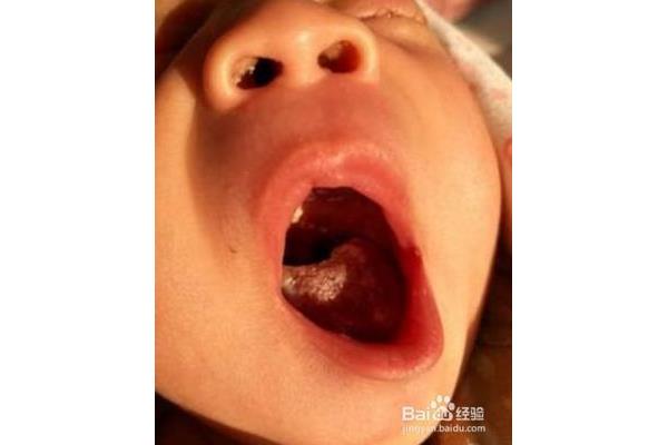 婴儿舌苔白