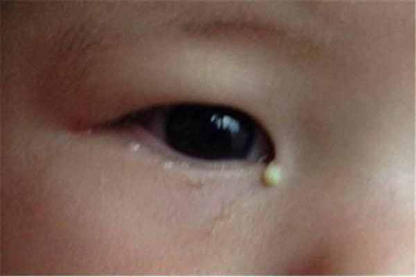 宝宝眼屎多