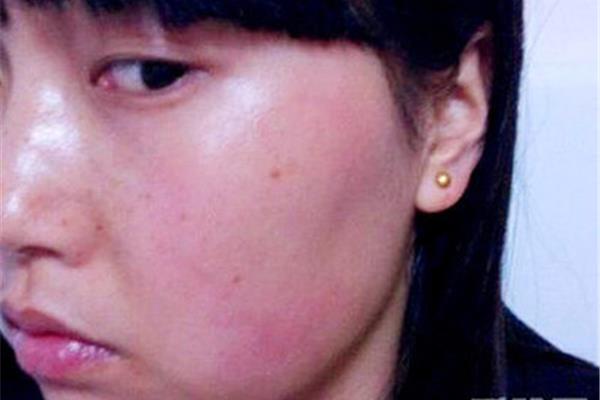 脸上脱皮怎么办