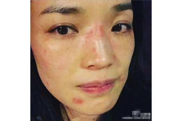 脸上脱皮怎么办