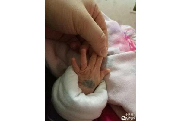 手上有胎记