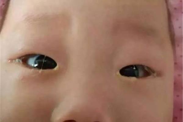 宝宝眼屎多