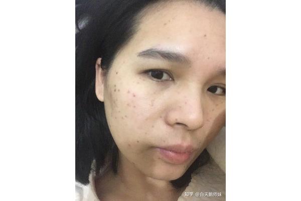 脸上脱皮怎么办