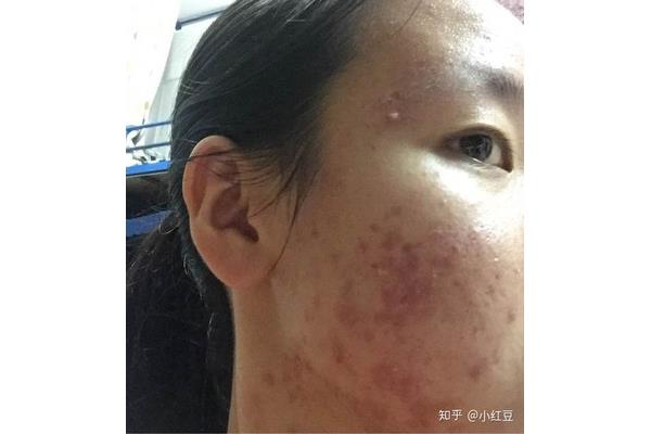 脸上脱皮怎么办