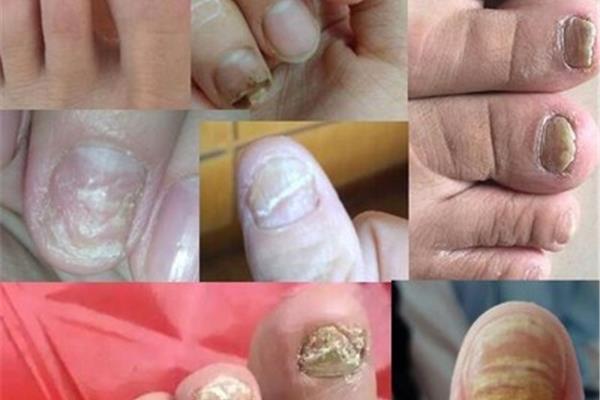 脚趾灰指甲