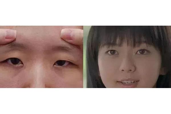 怎样治眼皮下垂