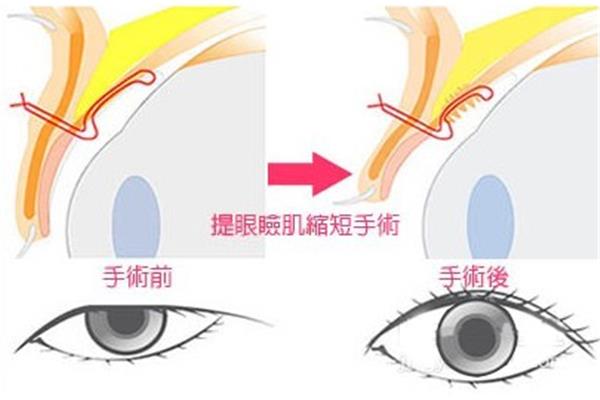 怎样治眼皮下垂