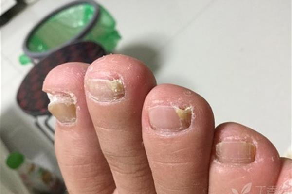 脚趾灰指甲