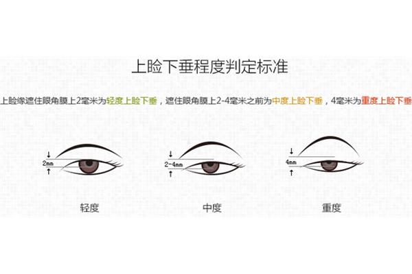 怎样治眼皮下垂