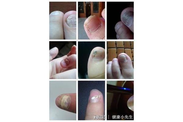 脚趾灰指甲