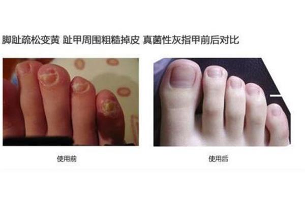 脚趾灰指甲