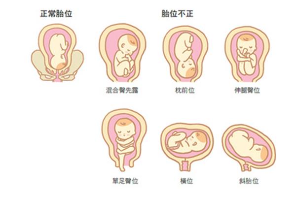 胎位不正的原因