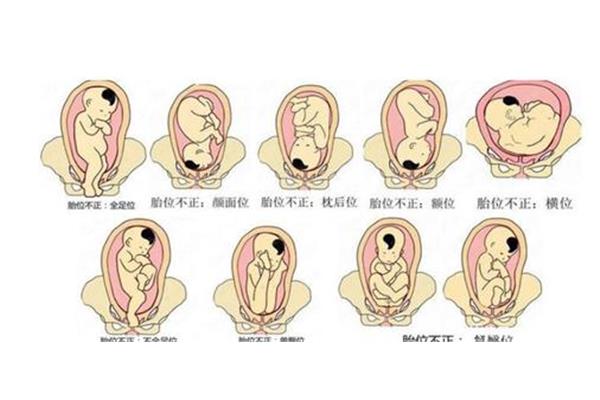 胎位不正的原因