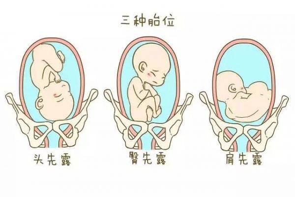 胎位不正的原因