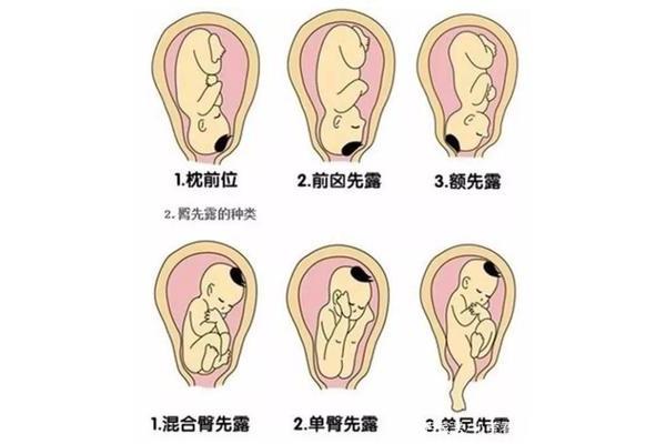 胎位不正的原因