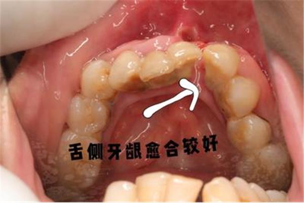 牙龈瘤手术费用