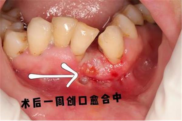 牙龈瘤手术费用