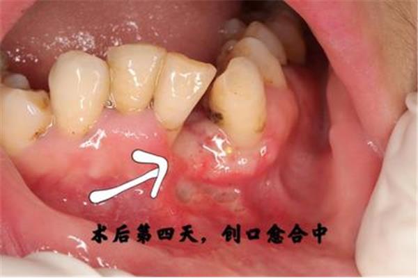 牙龈瘤手术费用
