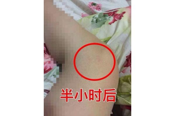 浮肿怎么办