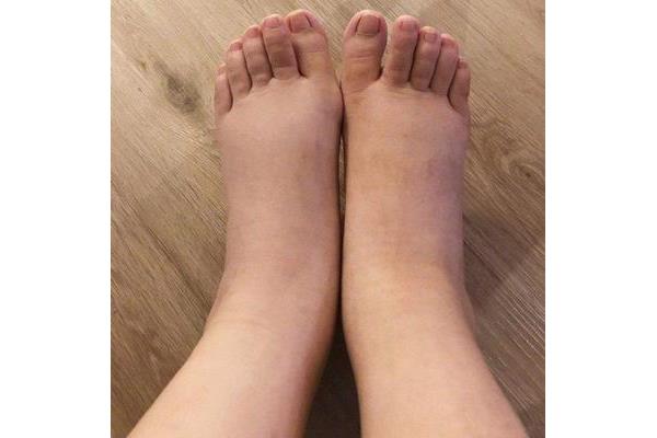 浮肿怎么办