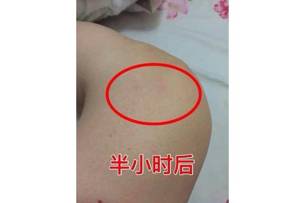 浮肿怎么办