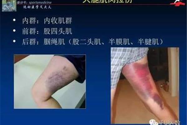 大腿内侧拉伤