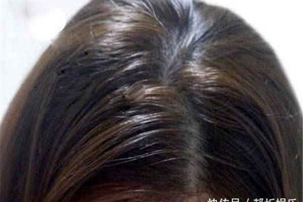 头发油是什么原因