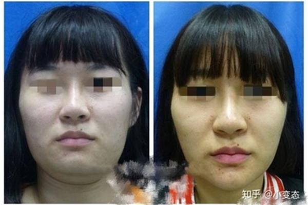脸胖怎么瘦