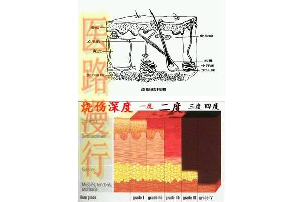 烫伤后会留疤吗