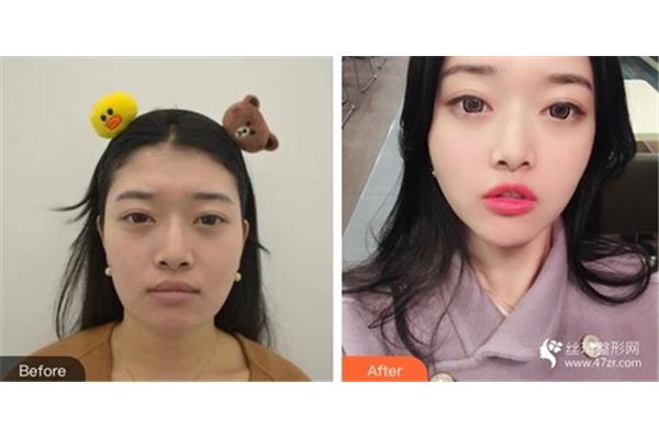 脸胖怎么瘦