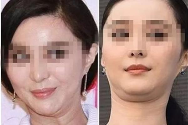脸胖怎么瘦