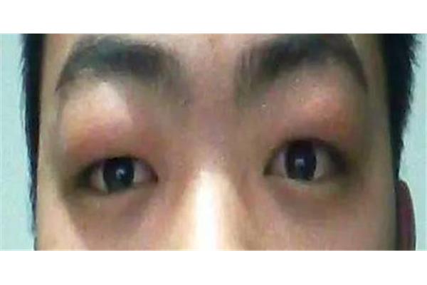 眼皮浮肿的原因