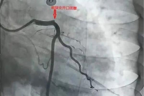 窦性心律正常吗