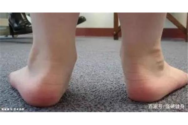 如何让小腿变细